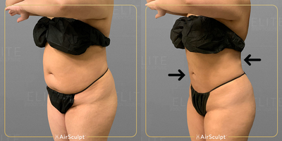35-44 year old woman treated with AirSculpt - Our featured Sacramento patient's before and afters show how we were able to sculpt a toned, flat belly around to her back just three months following her Stomach AirSculpt procedure.