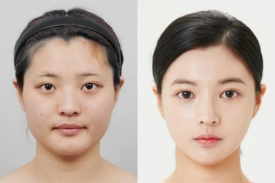 25-34 year old woman treated with V Line Surgery - Shaping Facial Contouring [Jaw reduction]
