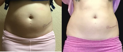 25-34 year old woman treated with truSculpt iD - 25-34 year old woman treated with truSculpt iD to upper/lower abdomen along with her flanks to loose fat. Patient also had TruSculpt Flex to tone and define the area.
