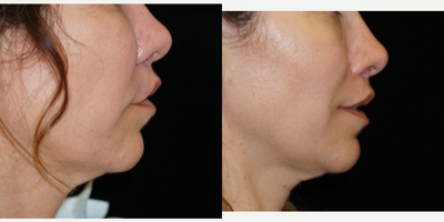 35-44 year old woman treated with Lip Repositioning - This patient came to me after she was unhappy from her previous lip lift. She was looking to have her upper teeth show slightly at rest, and she didnt like how her original lip lift did not address the lateral upper lip (this is very common).I performed a modified upper lip lift to address her concerns and give her the look she desired.