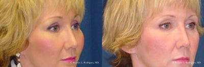 Woman in her early 40s treated with Brow Lift - Woman in her early 40s treated with Brow Lift to brighten up the eye area making her appear more aware and rejuvenated. Patient had only mild drooping (clinically referred to as ptosis) of the upper eyelids and wanted a 'refreshed' appearance.