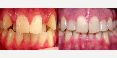 Invisalign - Invisalign