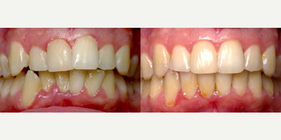 Invisalign - Invisalign