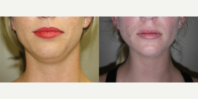 25-34 year old woman treated with Kybella - One vial of Kybella before and after views.