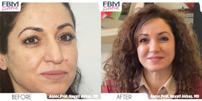 45-54 year old woman treated with Rhinoplasty, Chin Liposuction - 45-54 year old woman treated with Rhinoplasty, Chin Liposuction