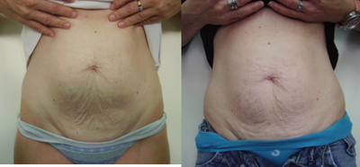 TriPollar - 
	Tummy skin tightening and fat reduction after 5 treatments. Photos supplied by manufacturer, Pollogen Ltd, All Rights Reserved.
