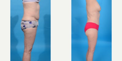45-54 year old woman treated with Abdominal Etching, Diastasis Recti Repair, Drainless Tummy Tuck, Liposculpture, Liposuction, M - Tummy Tuck/abdominoplasty revision. This patient had a tummy tuck by another surgeon and was unhappy with her result. I did a Tummy Tuck Revision. I removed and lowered her previous tummy tuck incision to make it lower and covered with a bikini (bikini incision). I did aggressive VASER ultrasound liposuction of her abdomen and waist (Lipo 360) to give her a flatter abdomen and more hourglass shape. I retightened her abdominal muscles using a 3 vector corset plication technique which flattens the abdomen and gives a more hourglass shape. I then removed all excess lower abdominal skin.