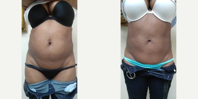 35-44 year old woman treated with Body-Jet Liposuction - 44 year old underwent liposuction of the abdomen. The photos represent the patient before and 1 year after the procedure.