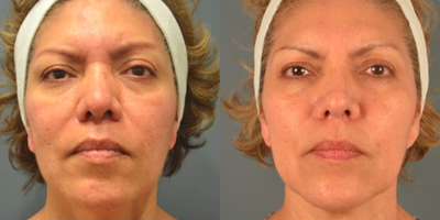 45-54 year old woman treated with Venus Viva - Venus Viva fractional radiofrequency/RF treatment is fantastic for facial resurfacing (wrinkles, sun spots, crepe skin, fine lines, pore reduction, and texture improvements), scars, and melasma. Since it is not a laser it can be used on all skin types (including darker skin and sensitive skin like those with eczema and/or rosacea). It is also fantastic for acne, as it helps the topical medications used to treat acne to penetrate the skin more readily. Long term tightening and lifting is improved with Venus Viva in combination with other skin tightening procedures such as radiofrequency/RF like Venus Legacy or ultrasound like Ultherapy.