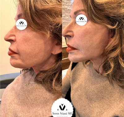 65-74 year old woman treated with NovaThreads, Thread Lift, Nonsurgical Facelift - Instant thread lift result in a 72 y.o Female patient. The results vary based on proper patient selection and properly performed treatment