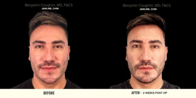 25-34 year old man treated with Jaw Surgery, Chin Implant - 25-34 year old man treated with Jaw Surgery and Chin Implant, resulting in a more masculine structure.