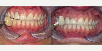 25-34 year old woman treated with Teeth Whitening - Patient did not like the color of her teeth and wants to have the front crowns replaced. The before shows the patient with shade A3.5. We achieved a shade of B1 in just two weeks with the use of KoR whitening at night. Now the patient is able to have her anterior crowns done and gingivectomy to achieve a more esthetic look. It would be better to veneer her front four teeth, but financially that is not an option so we opted for this conservative approach and it reduces the removal of natural healthy tooth structure from her upper left front teeth.