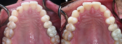 Treated with Pinhole Gum Surgery - Treated with Pinhole Gum Surgery
