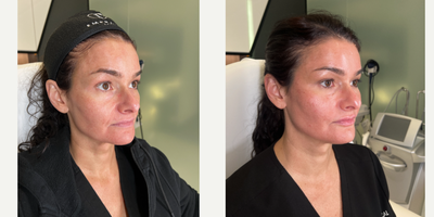 FILLER 'N THREADS COMBO - Our patient works in the industry so she would like to look her absolute best. She has noticed some signs of aging on her face, such as loss of volume in her mid face and prominent nasolabial folds. To correct this, we sculpted her face with filler as well as used threads- to give her a complete facial rejuvenation. We were able to define and sculpt her mid face leaving her cheeks contoured. We also gave her lips some natural looking plumpness, her chin that desired heart shaped look, and we didn't forget about defining her jaw for a snatched neck. All in all, she cannot believe how amazing she looks and is in love with her results!