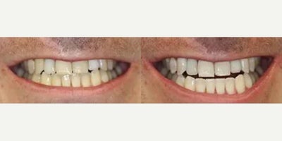Man treated with Teeth Whitening - Man treated with Teeth Whitening