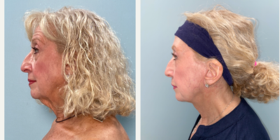 65-74 year old woman treated with Facelift, Neck Lift - Patient who underwent facelift with fat grafting.