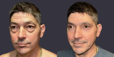 45-54 year old man treated with ActiveFX, CO2 Laser, Eyelid Surgery - This 48 year old man complained of sagging upper eyelids and puffy lower eyelids. Upper and lower blepharoplasty, (eyelid lift/surgery), including CO2 laser skin resurfacing around the eyes was done.