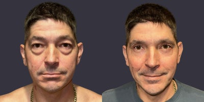45-54 year old man treated with ActiveFX, CO2 Laser, Eyelid Surgery - This 48 year old man complained of sagging upper eyelids and puffy lower eyelids. Upper and lower blepharoplasty, (eyelid lift/surgery), including CO2 laser skin resurfacing around the eyes was done.
