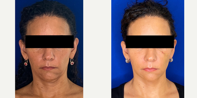 46 year old woman treated with Voluma - 46 year old woman treated with Voluma to cheeks shown 2 weeks post op. Patient was also treated with Botox to plastysma muscle on the nec to improve sagging and with no downtime.