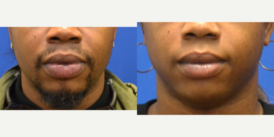 25-34 year old woman treated with Lip Reduction - lower lip reduction under local anesthesia