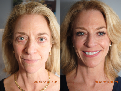 55-64 year old woman treated with Vampire Facelift - PRP Vampire Facelift56 yo, 54, 115 lbs, G2P2