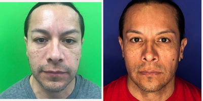 45-54 year old man treated with Vampire Facelift - Vampire Facelift, Botox, SkinTyte under the eyes, customized topical Rx skincare