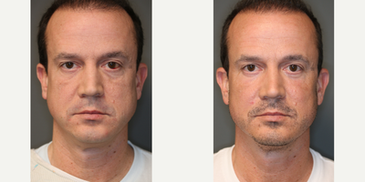 Lower Lid Eyebag and Festoon Removal with Laser and Fat Transfer - Lower lid eyebag and festoon removal with laser to full face and jawline and fat transfer.