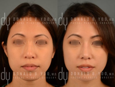Before and After Asian Rhinoplasty with DCF (diced cartilage fascia) - 32 yo pt underwent Asian rhinoplasty. A diced cartilage fascia (DCF) graft was used to achieve subtle augmentation of the bridge to create a straighter and more refined profile while the tip was projected and refined to create a smaller, more defined nasal appearance.