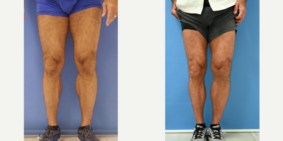55-64 year old man treated with Calf Implant - 61 year old male 2 years after exchange of his medial calf implants performed by Dr Sam Gershenbaum. His original medial calf implants placed, 2 years prior by another surgeon, had used non-tapered implants and were positioned at the wrong depth and in the wrong position resulting in a very unnatural appearance. Here two years after exchange of implants to Dr Gershenbaum's custom tapered implants replaced in the correct subfascial position now look full, shapely and muscular and very natural. Another very happy patient!