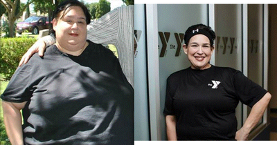 45-54 year old woman treated with Gastric Bypass - Gastric bypass