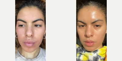 25-34 year old woman treated with Cosmelan - Results of Cosmelan depigmentation treatment.