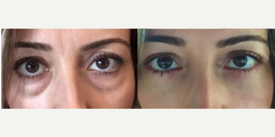 25-34 year old woman treated with Eyelid Surgery - Young female underwent lower eyelid surgery. She was concerned with her tired look and puffy bags. She underwent removal of lower eyelid fat, repositioning of fat near tear trough deformity and a lift of the corner of her lower lid to give her eyes a nice almond shape.