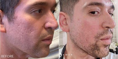 Man treated with Subcision, CO2 Laser - Man treated with Subcision, CO2 Laser