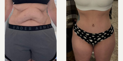 Woman treated with Lipo 360, Tummy Tuck - Woman treated with Lipo 360, Tummy Tuck
