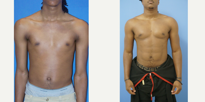 18-24 year old man treated with Pec Implants - 22 year old male from Georgia 3 months after pectoral implants placed by Dr Sam Gershenbaum. He had vertical rectangular soft solid silicone implants with 1.6cm of projection placed under the muscle. He looks well built and natural and is very pleased with his results.About 10 years later, you will see in the next set of pec implants, he has replaced them for larger.