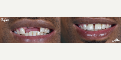 25-34 year old man treated with Dental Implants, Dental Crown, Dental Bone Graft - This patient lost his teeth in an accident when he was 14 years old.