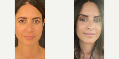 42 year old woman treated with Facial Fat Transfer - 42 year old woman treated with Lateral/Temporal Browlift, Lip Lift (corner lip lift), Nano and Macro Fat Grafting to Face, and Fractional CO2 Laser under lids. The procedure took about 2.5-3.5 hours under general anesthesia.