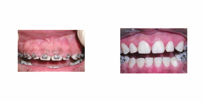 Gum enlargement treated with Gum Lift - 20 year old female developed gum enlargement due to chronic gingivitis with braces. Patient treated with laser gum lift to improve esthetics and hygiene