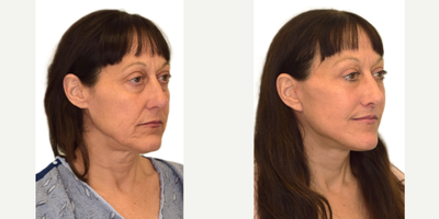 55-64 year old woman treated with Deep Plane Facelift, Brow Lift, Facial Fat Transfer, Eyelid Surgery, Lip Lift, Ellacor - 1. Extended deep-plane facelift2. Temporal brow lift3. Fat grafting to tear troughs and nasolabial folds4. Upper blepharoplasty5. Lip lift6. Ellacor to the forehead and perioral region