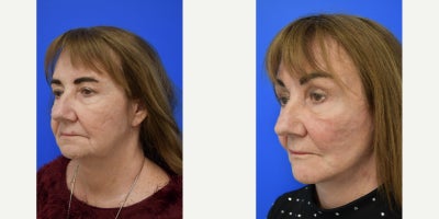 65-74 year old woman treated with Brow Lift, Facelift, SMAS Facelift - This 68 year old woman had recently lost weight with a GLP-1. She has some aging from the weight loss and she has a heavy brow. We decided to do a facelift and a brow lift. This brow lift was a gliding brow lift, not endoscopic. No endotines were used. Please see our website for more information on our gliding brow lift.