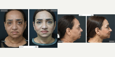 55-64 year old woman treated with Facelift, MACS Facelift, Neck Lift - Macs Facelift with Neck Lift