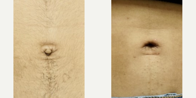 25-34 year old woman treated with Belly Button Surgery - 25-34 year old woman seeking improved belly button shape, treated with umbilicoplasty (belly button surgery)