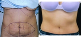 Panniculectomy - Panniculectomy