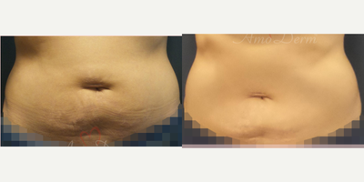 35-44 year old woman treated with SculpSure - Non-surgical removal of stubborn fat in belly and flanks with SculpSure (compare with CoolSculpting)