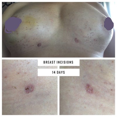 Tuberous Breast Correction Using Coleman Fat Grafting