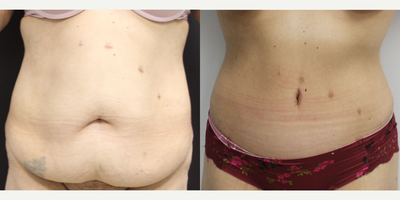 45-54 year old woman treated with Tummy Tuck - Circumferential  after massive weight loss