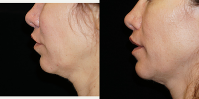 35-44 year old woman treated with Lip Repositioning - This beautiful patient was interested in a revision lip lift after her original procedure addressed her mid upper lip, but did not lift the lateral upper lip. A lift of the lateral upper lip is one of the most difficult areas to address in a lip lift. I performed a modified upper lip lift to address the lateral areas and improve her tooth show at rest. Here she 3 months post procedure.