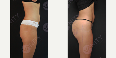 25-34 year old woman treated with Brazilian Butt Lift Revision - 25-34 year old woman treated with Brazilian Butt Lift, Brazilian Butt Lift Revision, Butt Implants