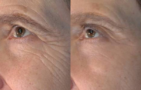 45-54 year old woman treated with Vivace - Vivace before and after