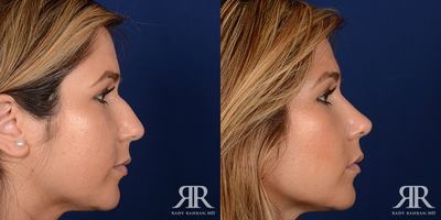 Rhinoplasty - Rhinoplasty